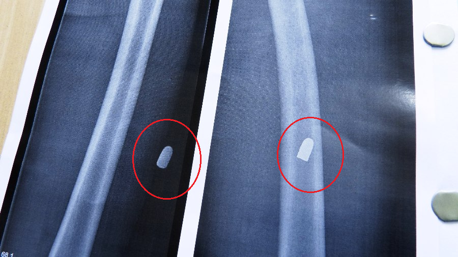 Radiografia mostra os projetis ainda alojados nas pernas do suspeitos